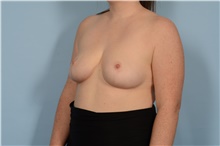 Breast Reduction After Photo by Ellen Janetzke, MD; Bloomfield Hills, MI - Case 47579