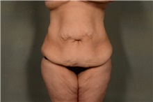 Tummy Tuck Before Photo by Ellen Janetzke, MD; Bloomfield Hills, MI - Case 47580