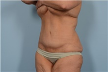Tummy Tuck After Photo by Ellen Janetzke, MD; Bloomfield Hills, MI - Case 47580