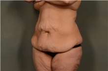 Tummy Tuck Before Photo by Ellen Janetzke, MD; Bloomfield Hills, MI - Case 47580