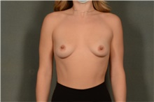 Breast Augmentation Before Photo by Ellen Janetzke, MD; Bloomfield Hills, MI - Case 47581