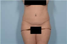 Tummy Tuck After Photo by Ellen Janetzke, MD; Bloomfield Hills, MI - Case 47582