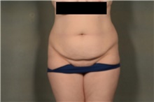 Tummy Tuck Before Photo by Ellen Janetzke, MD; Bloomfield Hills, MI - Case 47582