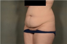 Tummy Tuck Before Photo by Ellen Janetzke, MD; Bloomfield Hills, MI - Case 47582