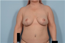 Breast Lift After Photo by Ellen Janetzke, MD; Bloomfield Hills, MI - Case 47583