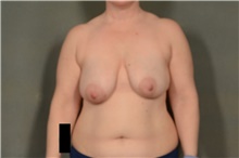 Breast Lift Before Photo by Ellen Janetzke, MD; Bloomfield Hills, MI - Case 47583