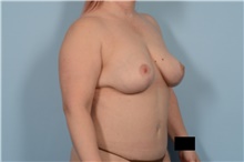 Breast Lift After Photo by Ellen Janetzke, MD; Bloomfield Hills, MI - Case 47583