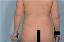 Liposuction After Photo by Ellen Janetzke, MD; Bloomfield Hills, MI - Case 47584