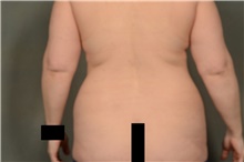 Liposuction Before Photo by Ellen Janetzke, MD; Bloomfield Hills, MI - Case 47584