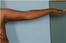 Arm Lift After Photo by Ellen Janetzke, MD; Bloomfield Hills, MI - Case 47589