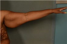 Arm Lift Before Photo by Ellen Janetzke, MD; Bloomfield Hills, MI - Case 47589