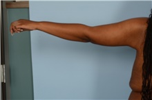 Arm Lift After Photo by Ellen Janetzke, MD; Bloomfield Hills, MI - Case 47589