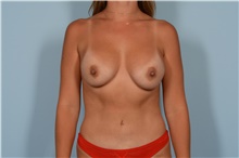 Breast Augmentation After Photo by Ellen Janetzke, MD; Bloomfield Hills, MI - Case 47631