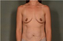 Breast Augmentation Before Photo by Ellen Janetzke, MD; Bloomfield Hills, MI - Case 47631