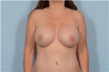 Breast Augmentation After Photo by Ellen Janetzke, MD; Bloomfield Hills, MI - Case 47632