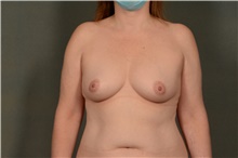 Breast Augmentation Before Photo by Ellen Janetzke, MD; Bloomfield Hills, MI - Case 47632