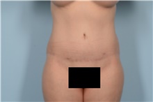 Tummy Tuck After Photo by Ellen Janetzke, MD; Bloomfield Hills, MI - Case 47633