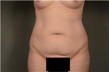 Tummy Tuck Before Photo by Ellen Janetzke, MD; Bloomfield Hills, MI - Case 47633