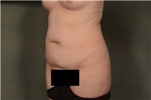 Tummy Tuck Before Photo by Ellen Janetzke, MD; Bloomfield Hills, MI - Case 47633