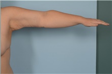 Arm Lift After Photo by Ellen Janetzke, MD; Bloomfield Hills, MI - Case 47808