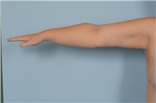 Arm Lift After Photo by Ellen Janetzke, MD; Bloomfield Hills, MI - Case 47808