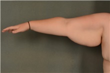 Arm Lift Before Photo by Ellen Janetzke, MD; Bloomfield Hills, MI - Case 47808