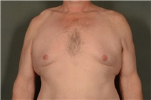 Male Breast Reduction Before Photo by Ellen Janetzke, MD; Bloomfield Hills, MI - Case 47814