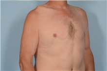 Male Breast Reduction After Photo by Ellen Janetzke, MD; Bloomfield Hills, MI - Case 47814