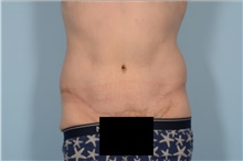 Tummy Tuck After Photo by Ellen Janetzke, MD; Bloomfield Hills, MI - Case 47815