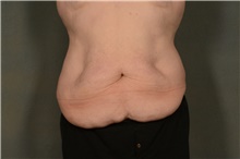Tummy Tuck Before Photo by Ellen Janetzke, MD; Bloomfield Hills, MI - Case 47815