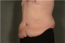 Tummy Tuck Before Photo by Ellen Janetzke, MD; Bloomfield Hills, MI - Case 47815