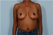 Breast Reduction After Photo by Ellen Janetzke, MD; Bloomfield Hills, MI - Case 47837