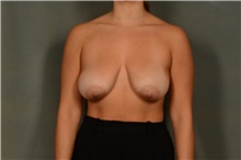 Breast Reduction Before Photo by Ellen Janetzke, MD; Bloomfield Hills, MI - Case 47963