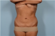 Liposuction After Photo by Ellen Janetzke, MD; Bloomfield Hills, MI - Case 47964