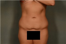 Liposuction Before Photo by Ellen Janetzke, MD; Bloomfield Hills, MI - Case 47964