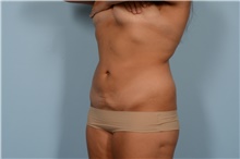 Liposuction After Photo by Ellen Janetzke, MD; Bloomfield Hills, MI - Case 47964