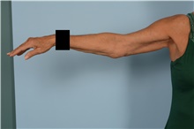 Arm Lift After Photo by Ellen Janetzke, MD; Bloomfield Hills, MI - Case 47965