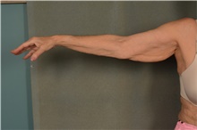 Arm Lift Before Photo by Ellen Janetzke, MD; Bloomfield Hills, MI - Case 47965