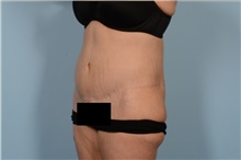 Tummy Tuck After Photo by Ellen Janetzke, MD; Bloomfield Hills, MI - Case 47966
