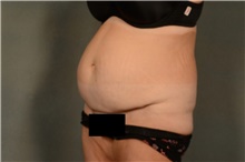 Tummy Tuck Before Photo by Ellen Janetzke, MD; Bloomfield Hills, MI - Case 47966