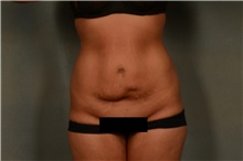 Tummy Tuck Before Photo by Ellen Janetzke, MD; Bloomfield Hills, MI - Case 47969