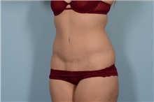 Tummy Tuck After Photo by Ellen Janetzke, MD; Bloomfield Hills, MI - Case 47969