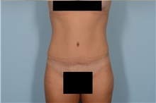 Tummy Tuck After Photo by Ellen Janetzke, MD; Bloomfield Hills, MI - Case 47970
