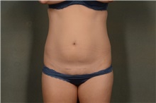 Tummy Tuck Before Photo by Ellen Janetzke, MD; Bloomfield Hills, MI - Case 47970