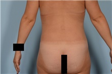 Liposuction After Photo by Ellen Janetzke, MD; Bloomfield Hills, MI - Case 47971
