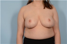 Breast Reduction After Photo by Ellen Janetzke, MD; Bloomfield Hills, MI - Case 48243