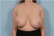 Breast Reduction Before Photo by Ellen Janetzke, MD; Bloomfield Hills, MI - Case 48243