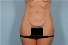 Tummy Tuck Before Photo by Ellen Janetzke, MD; Bloomfield Hills, MI - Case 48244
