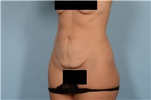 Tummy Tuck Before Photo by Ellen Janetzke, MD; Bloomfield Hills, MI - Case 48244