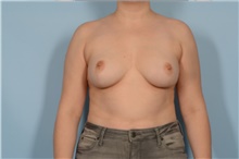 Breast Reduction After Photo by Ellen Janetzke, MD; Bloomfield Hills, MI - Case 48260